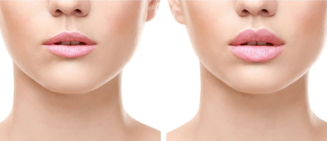Top Lip Filler Trends for 2026: Achieving Natural, Plump Results