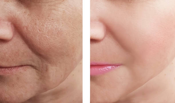 The Lift of the Future: Why Profhilo Structura is the New Gold Standard for Facial Restoration
